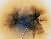 Pulmonary clot causing a heart attack