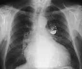 Pacemaker for heart failure,X-ray