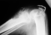 Cancerous growth in knee joint,X-ray