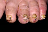Surgical treatment of bunion