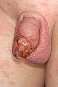 Infected circumcision wound
