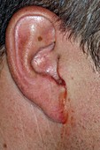 Perforated eardrum with infection