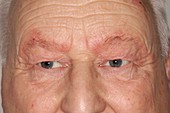 Seborrhoeic dermatitis around eyes