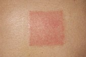 Skin irritation from transdermal patch