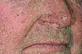 Exfoliative dermatitis