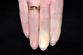 Raynaud's phenomenon in finger