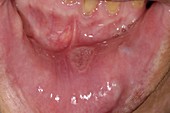 Aphthous ulcer in the mouth
