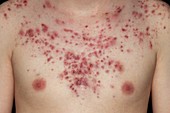 Acne on the shoulders and chest