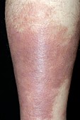 Pigmentation after cellulitis of the leg