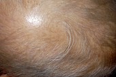 Fine hair in ectodermal dysplasia