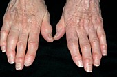 Osteoarthritis of the fingers