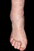 Osteoarthritis of ankle