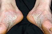 Acute psoriasis on the feet