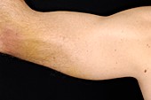 Torn triceps muscle of the arm