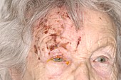 Shingles rash on the head