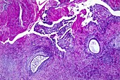 Pelvic endometriosis,light micrograph