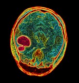 Brain tumour,MRI scan