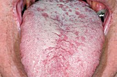 Thrush (Candida) on the tongue