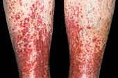 Purpuric rash from warfarin drug