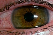 Corneal abrasion from contact lens