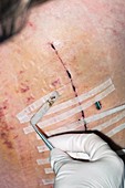 Removing steri-strips