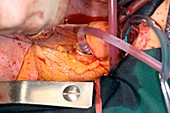 Aortic valve replacement surgery