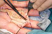 Dupuytren's contracture hand surgery