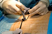 Laparoscopic prostate surgery