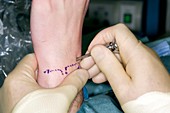 Arthroscopic wrist surgery