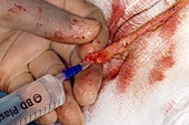 Preparing artery for heart bypass surgery