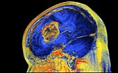 Brain tumour,3-D MRI scan