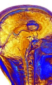 Brain tumour,3-D MRI scan