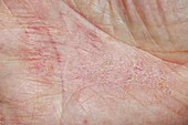 Dermatitis on the hand
