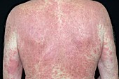 Eczema on the torso