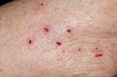Scratch marks on arm in eczema