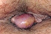 Thrombosed haemorrhoid (pile) on anus