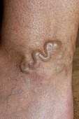 Varicose vein in the leg