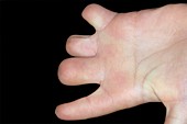 Deformed fingers from amniotic bands