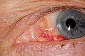 Choroidal neovascularisation of eye