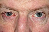 Blepharitis of the eye