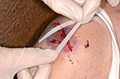 Steristrips applied to shoulder wound