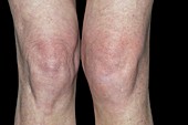 Swollen joint of the knee after a fall