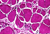 Muscular dystrophy,light micrograph