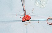 Laparoscopic colon cancer surgery