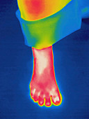 Thermogram,foot,temperature variation