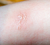 Poison Ivy rash on human skin