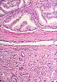 Prostate cancer,light micrograph