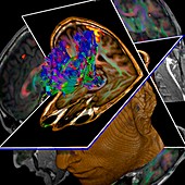Brain tumour,DTI and MRI scans