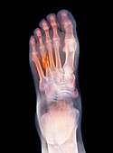 Fractured foot,X-ray