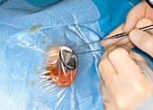 Middle ear surgery